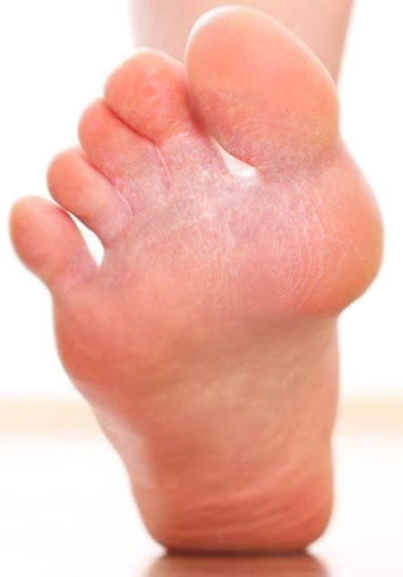 Athlete's Foot Treatment - Tinea Pedis - Colorado Springs & Monument, CO