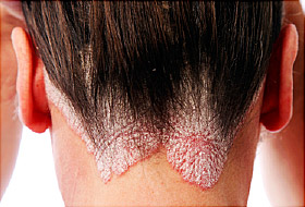 clinical studies for scalp psoriasis