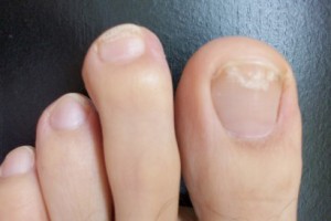 onychomycosis clinical trials