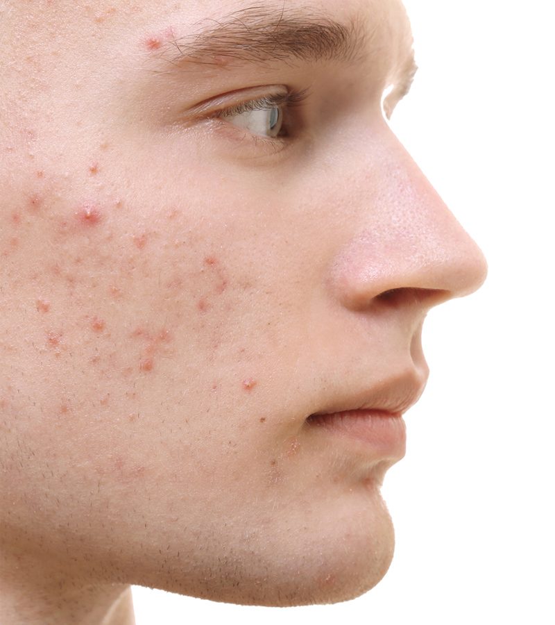 new research on acne