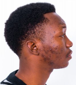 moderate acne